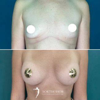 увеличение груди имплантатами 355 мл - 7 месяцев после операции